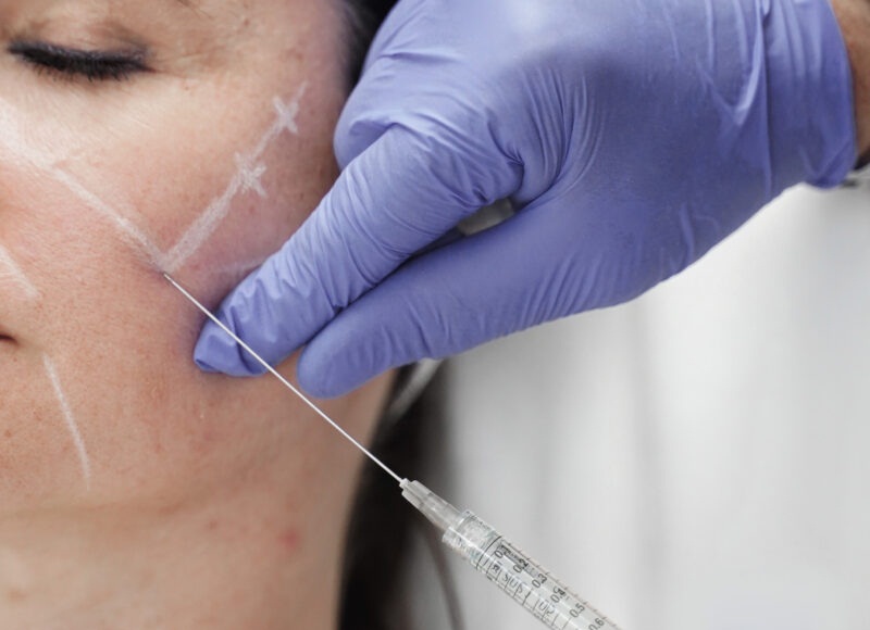 Fillers (Hyaluronic Acid) - Reine Medico-Aesthetics