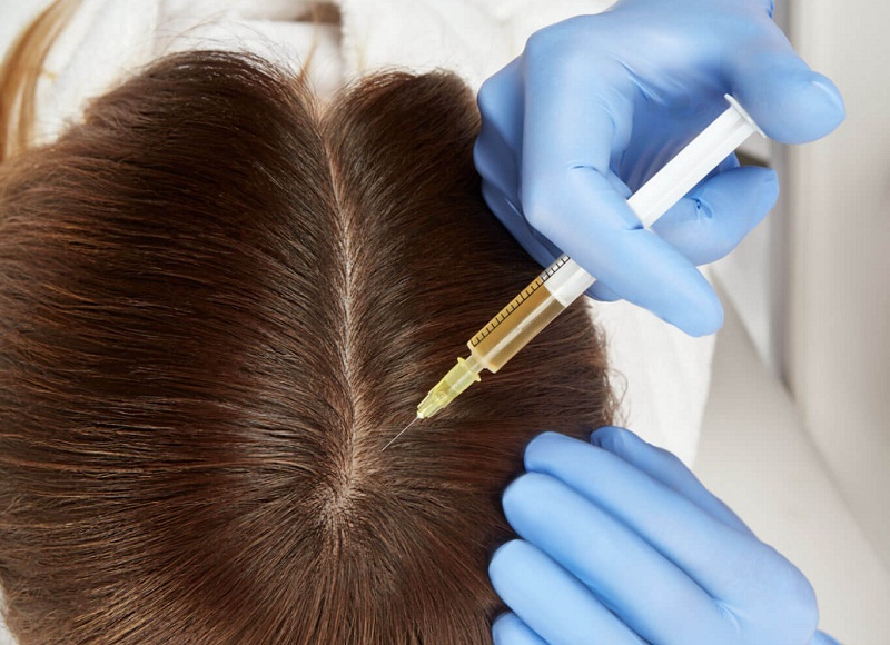 PRP for hair loss - Reine Medico-Aesthetics