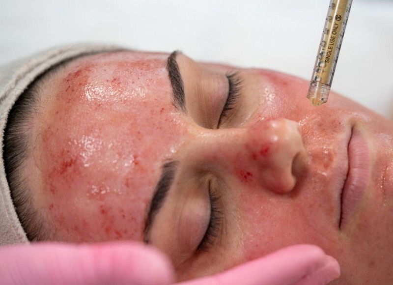 PRP for the face - Reine Medico-Aesthetics