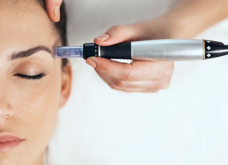 Micro-needling - Reine Medico-Aesthetics